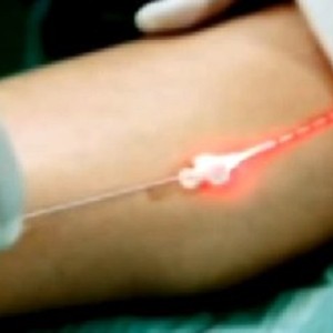 Эндовенозная лазерная коагуляция и ее преимущества